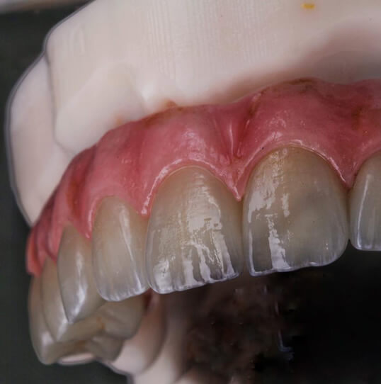 Tratamento de Implante Dentário
